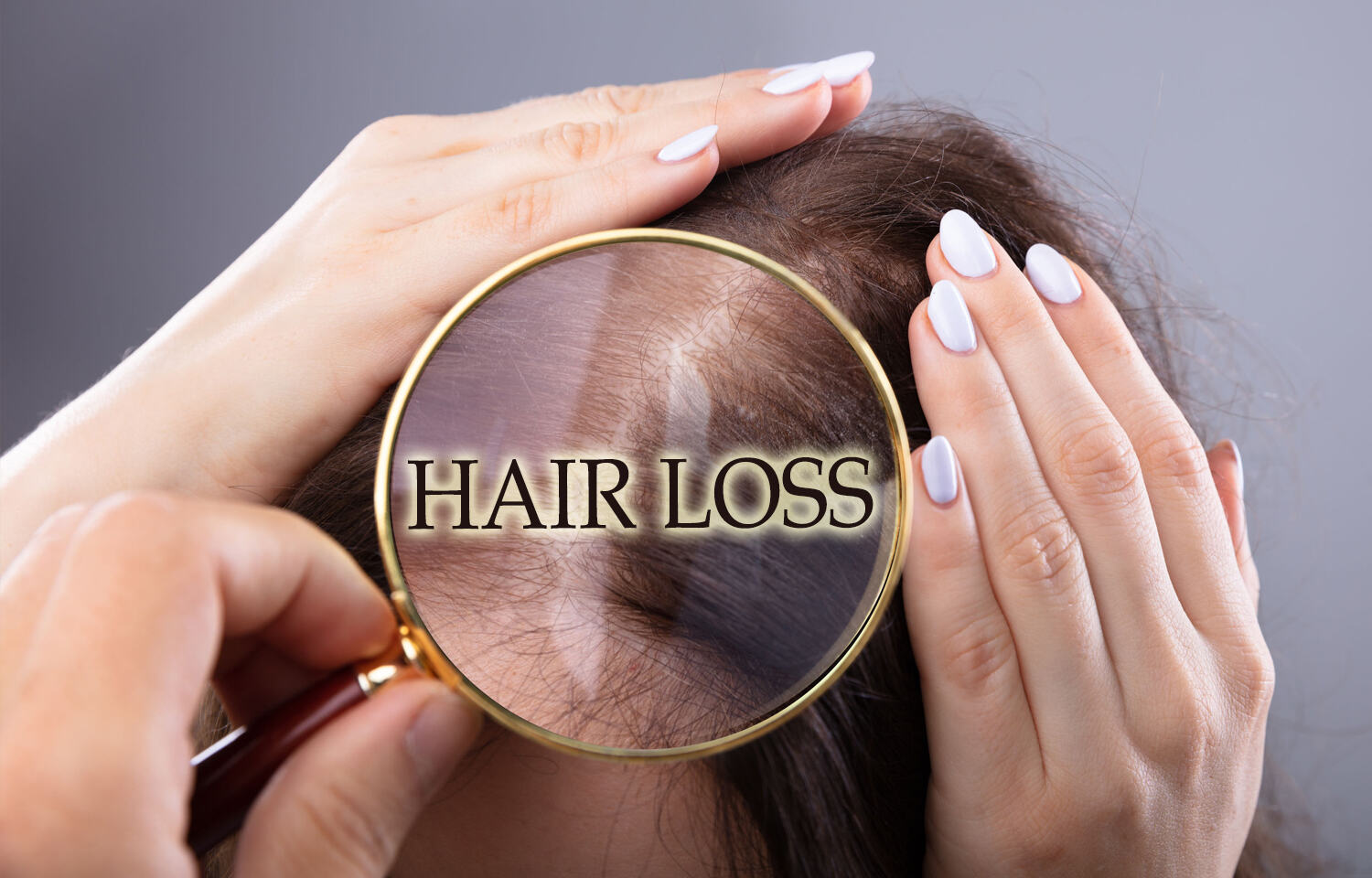 Hair loss frequent in acne patients treated with low dose isotretinoin vs  high dose