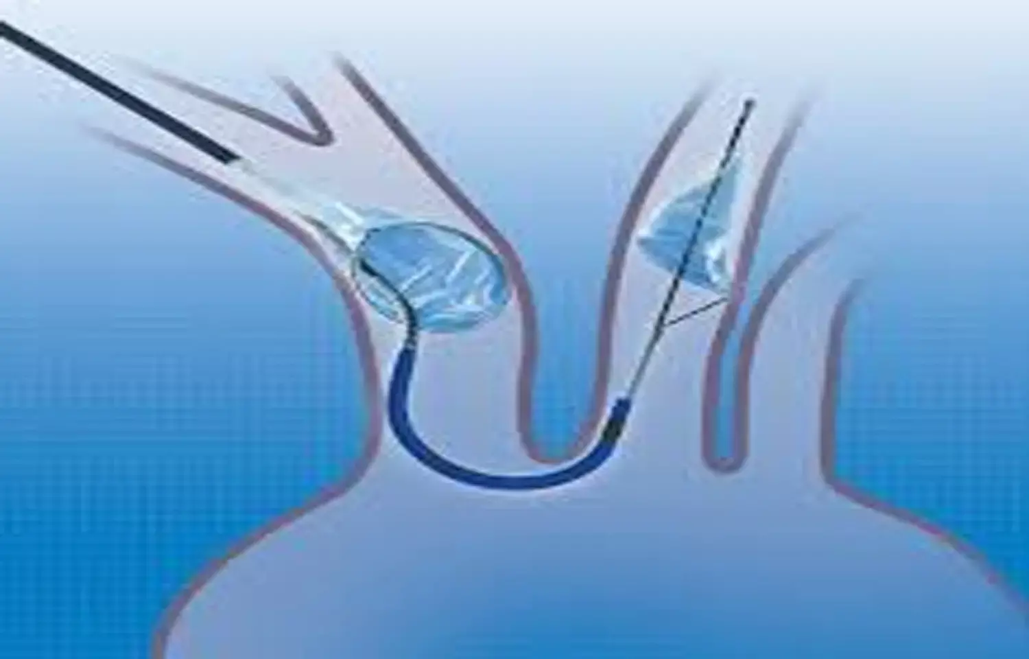 Cerebral protection system reduces stroke risk in patients undergoing TAVR: JACC Cerebral protection system reduces stroke risk in patients undergoing TAVR: JACC