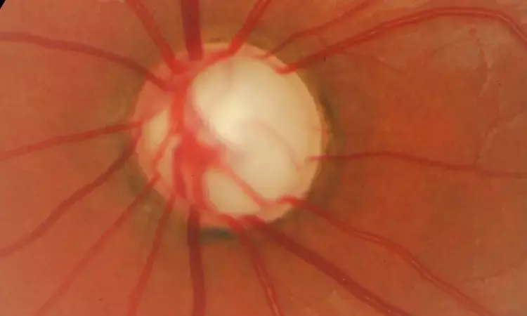 Initial trabeculectomy significantly reduces proportion of glaucoma progressing eyes: TAGS Study