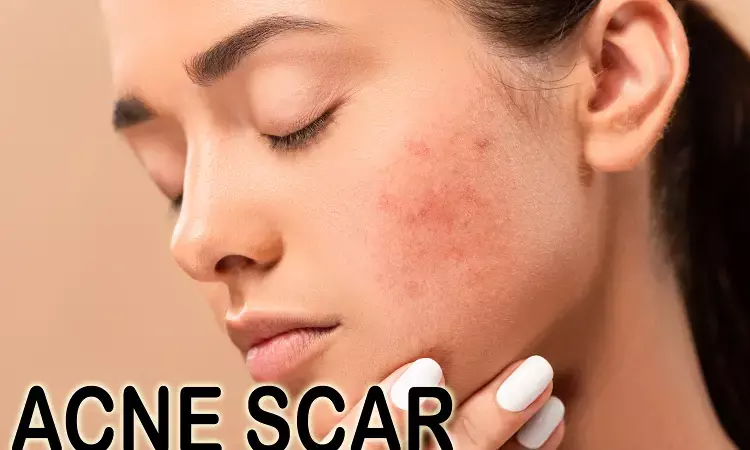 Fractional carbon dioxide laser monotherapy improves acne scars