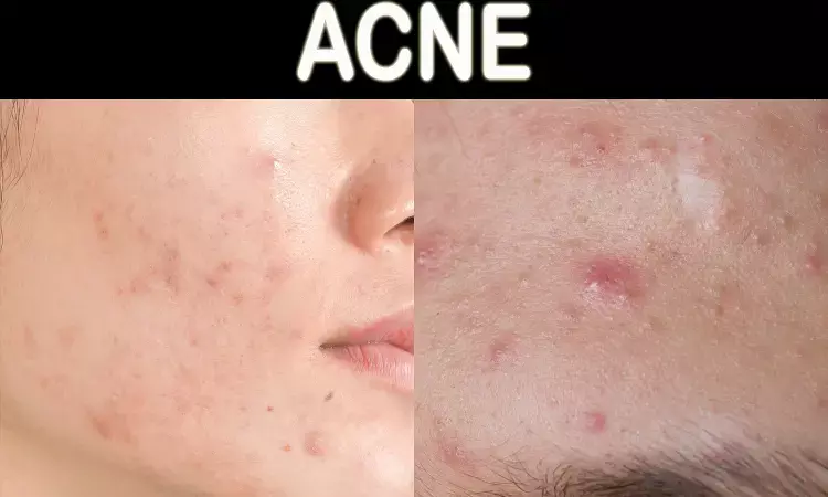 Trifarotene in moderate acne: No study data for the assessment of the added benefit