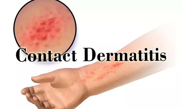 Allergic contact dermatitis due to chromium, cobalt release from metallic ear rings