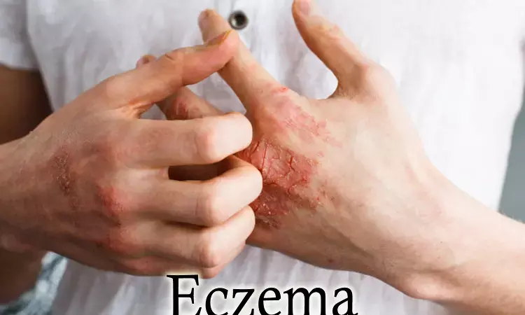 Maternal Vit D intake protects infants against Atopic eczema