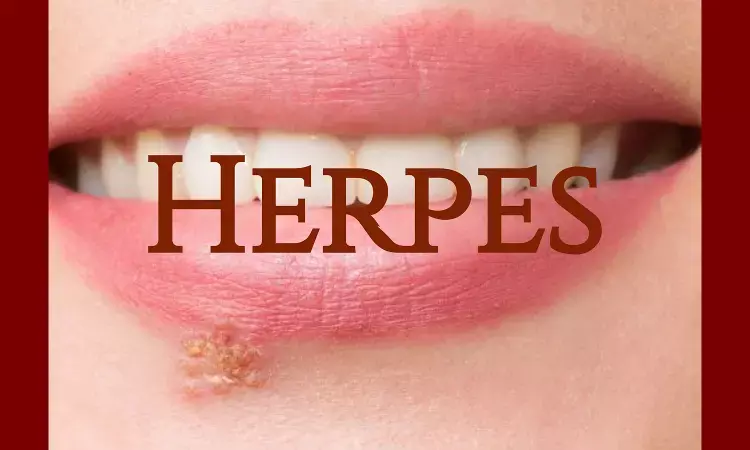 Vaccine shows promise against herpes virus