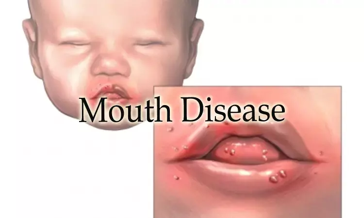 Patients of early onset Sjogrens syndrome may present with features of no or low dryness of mouth