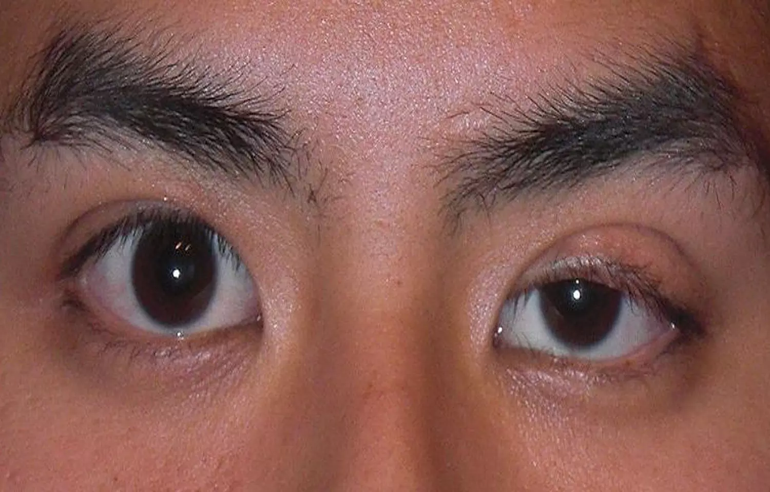 Rare case of Progressive Worsening of Unilateral Ptosis in Woman- A report