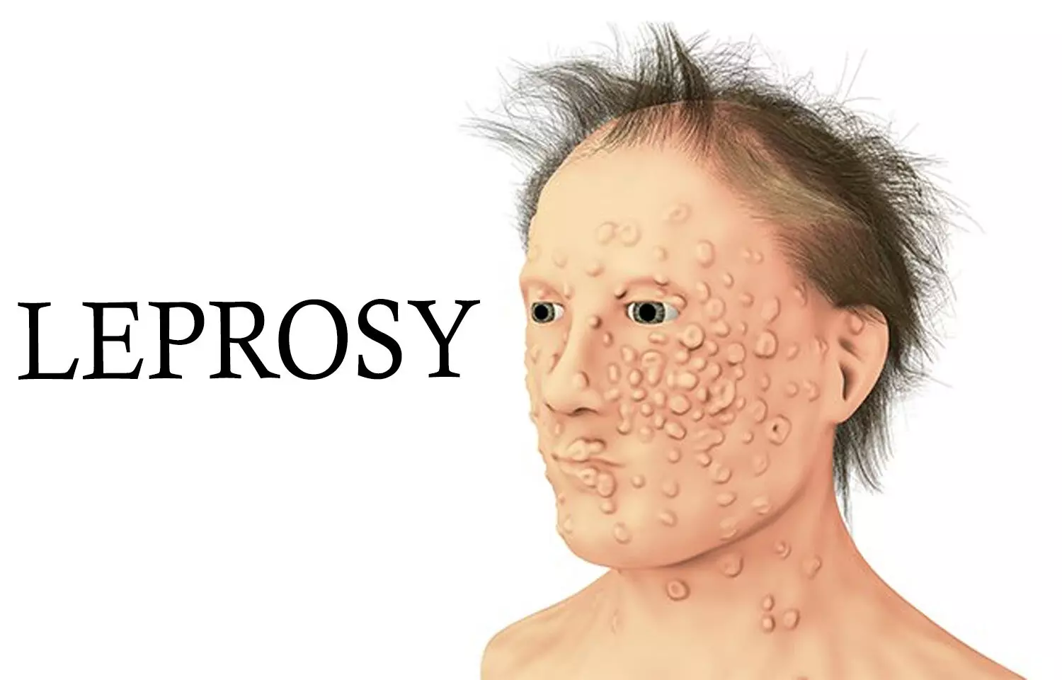 RT-PCR Detects Low-Bacillary Leprosy More Accurately Than Slit-Skin Smears: Pilot Study RT-PCR Detects Low-Bacillary Leprosy More Accurately Than Slit-Skin Smears: Pilot Study