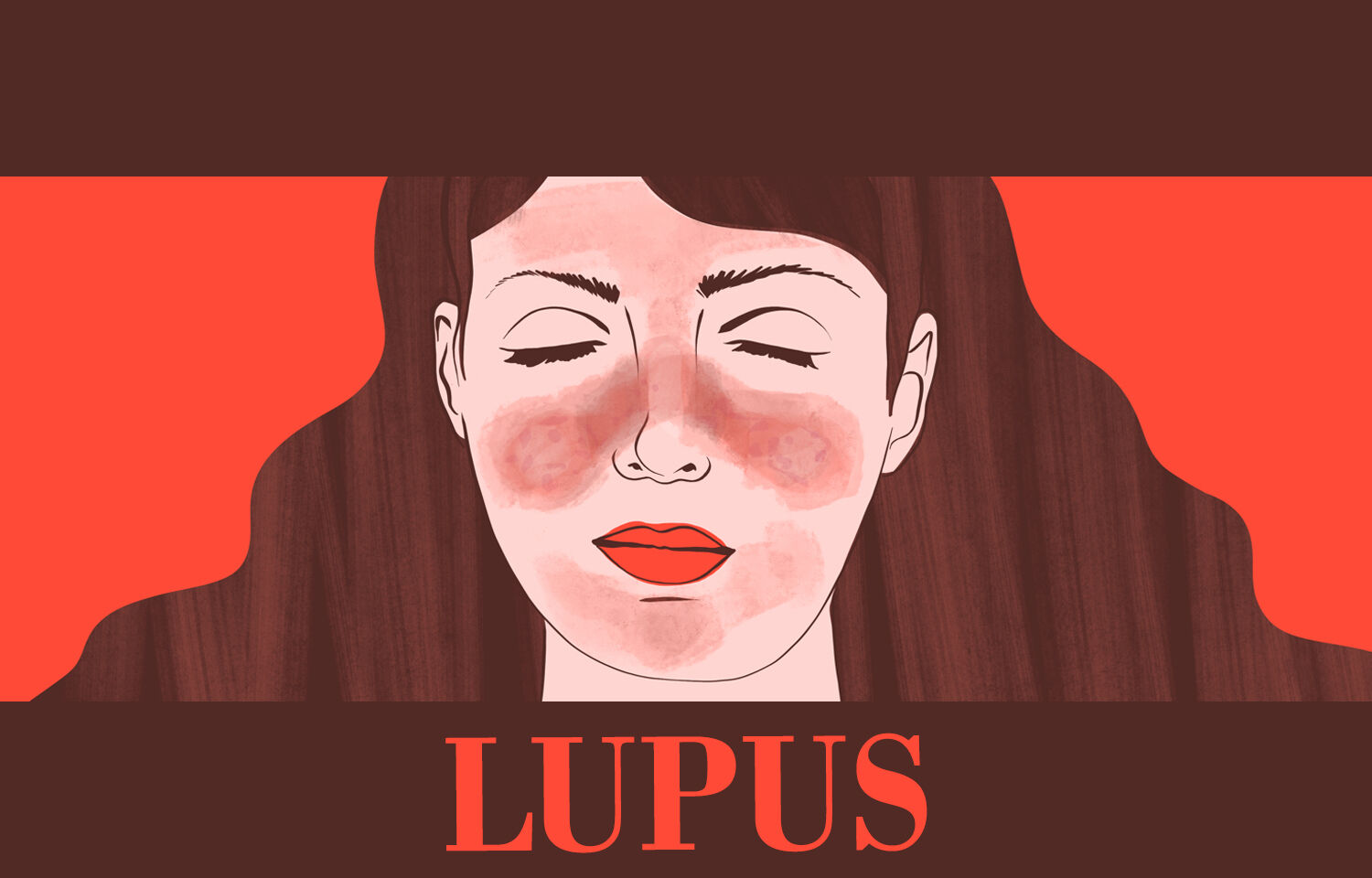 Active Systemic Lupus Erythematosus Patients More Susceptible To Infections Bmj 3288