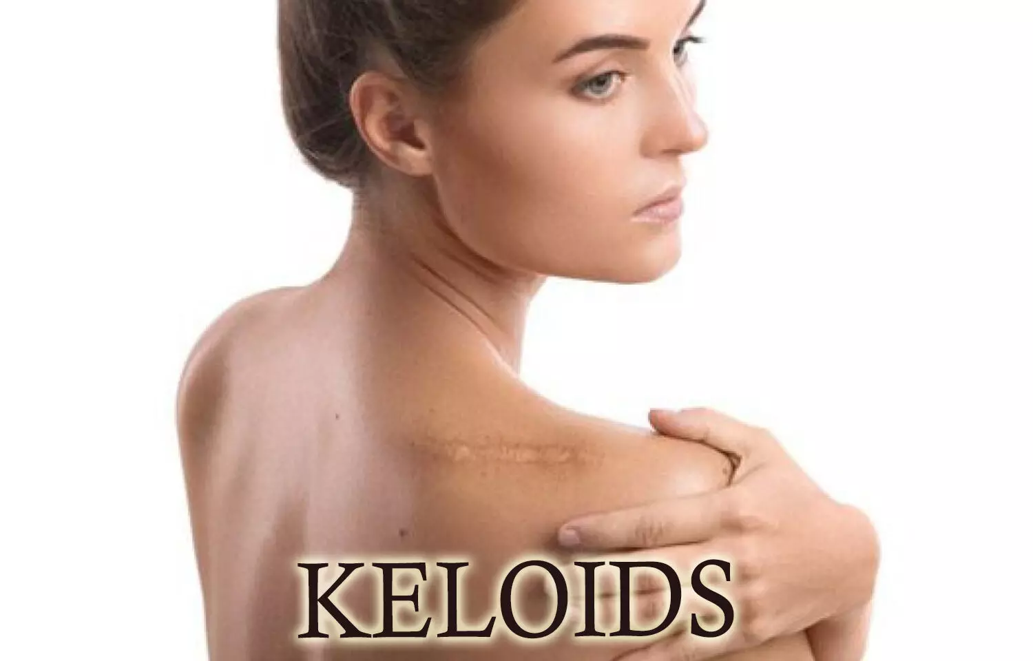 Novel therapies for keloids - a review