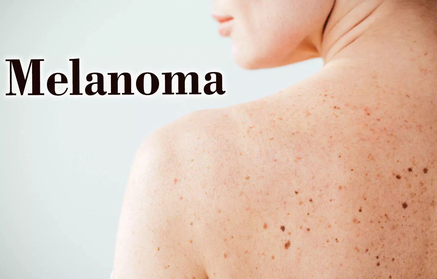 Dietary fiber improves outcomes for melanoma patients on immunotherapy, research shows