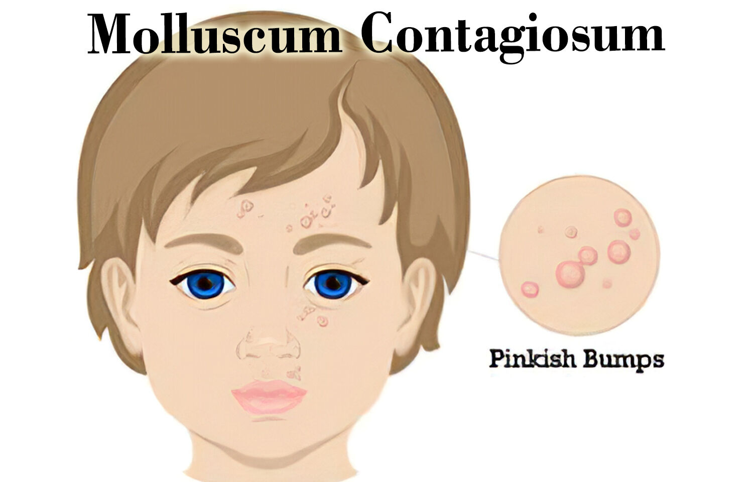 New treatment for Molluscum Contagiosum receives FDA approval