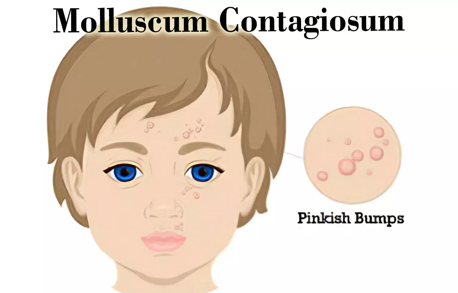 Autoinoculation, promising for molluscum contagiosum treatment: Study