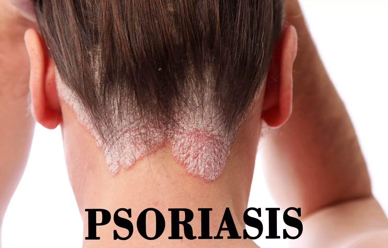 Glycerin may help calm classic scaly, red, raised and itchy patches in psoriasis