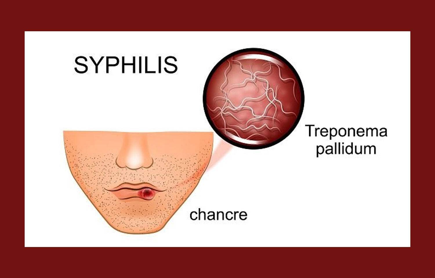 screening-for-syphilis-must-for-individuals-who-are-at-high-risk