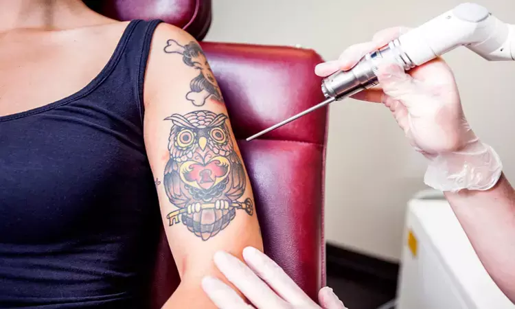 Tattooing disrupts sweat secretion causing body to overheat, suggests study