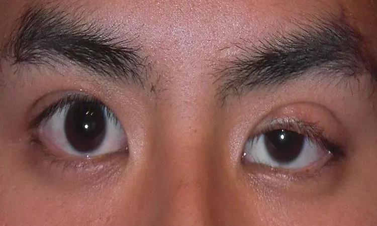 Rare case of Progressive Worsening of Unilateral Ptosis in Woman- A report