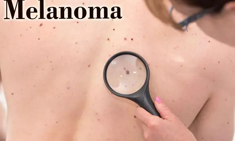AI may help identify melanoma survivors at high risk of cancer recurrence