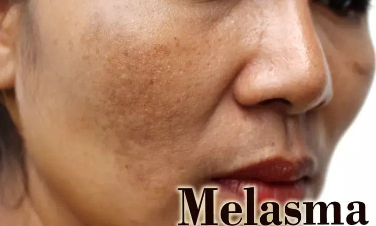 Oral Tranexamic Acid effective and well tolerated treatment for melasma