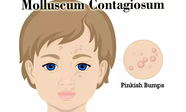 FDA approves  first treatment for Molluscum contagiosum