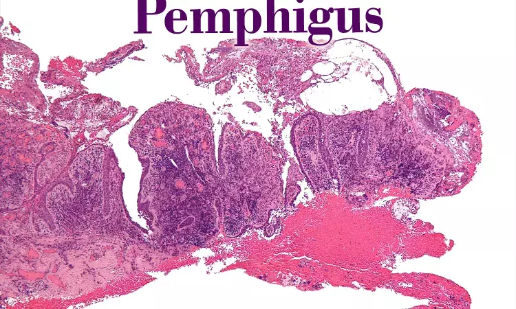 Female pemphigus patients at an increased risk of developing RA, Finds study