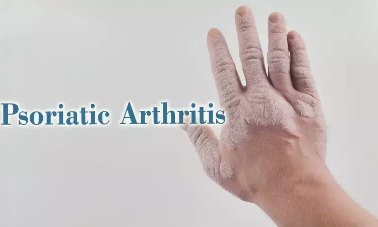 SLE more prevalent in psoriatic arthritis patients: Study