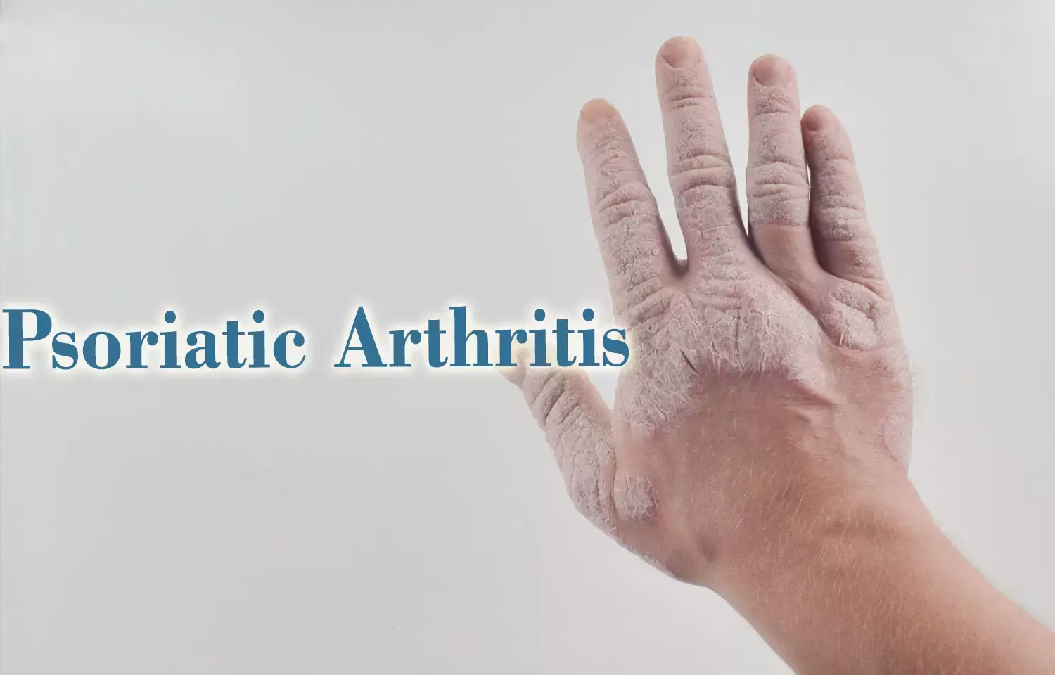 Brodalumab substantially improves   symptoms in psoriatic arthritis, reports Study