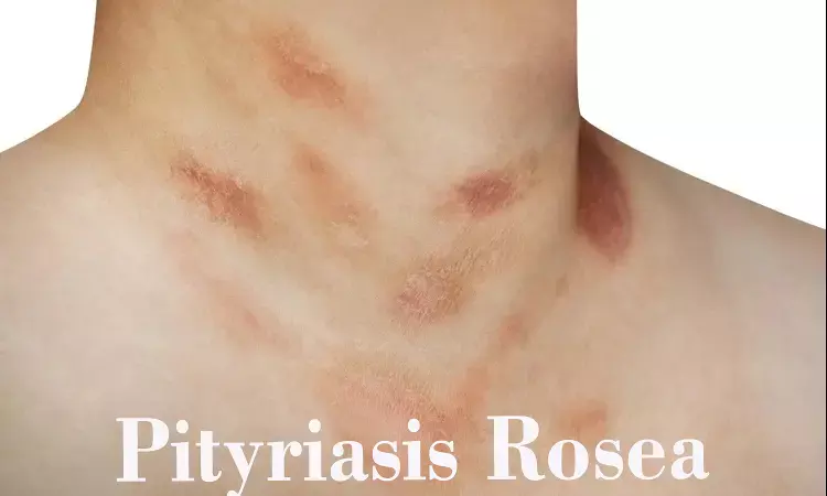 Pityriasis rosea does not affect pregnancy outcomes: Study