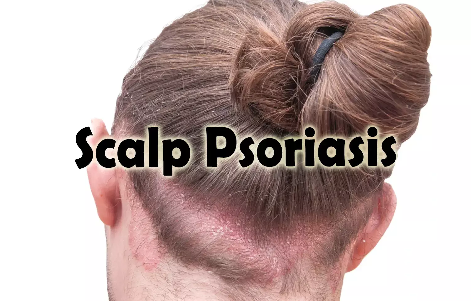 Tildrakizumab Sustains Long-Term Efficacy for Scalp Psoriasis Treatment,  reveals research