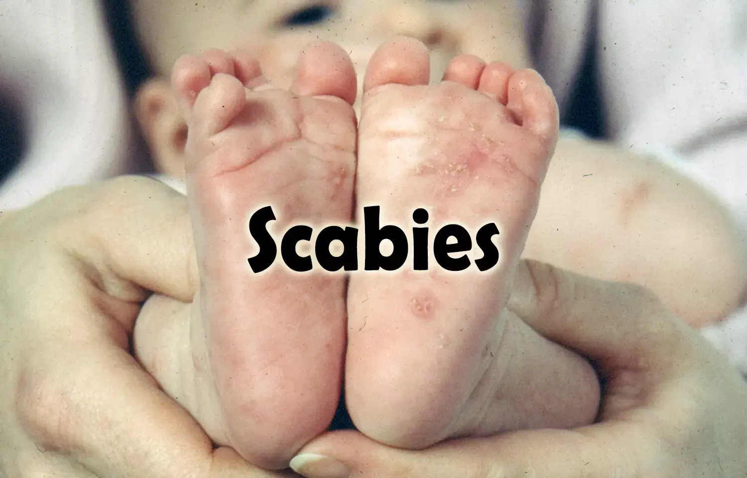 Single dose of Ivermectin just as effective as two for scabies treatment