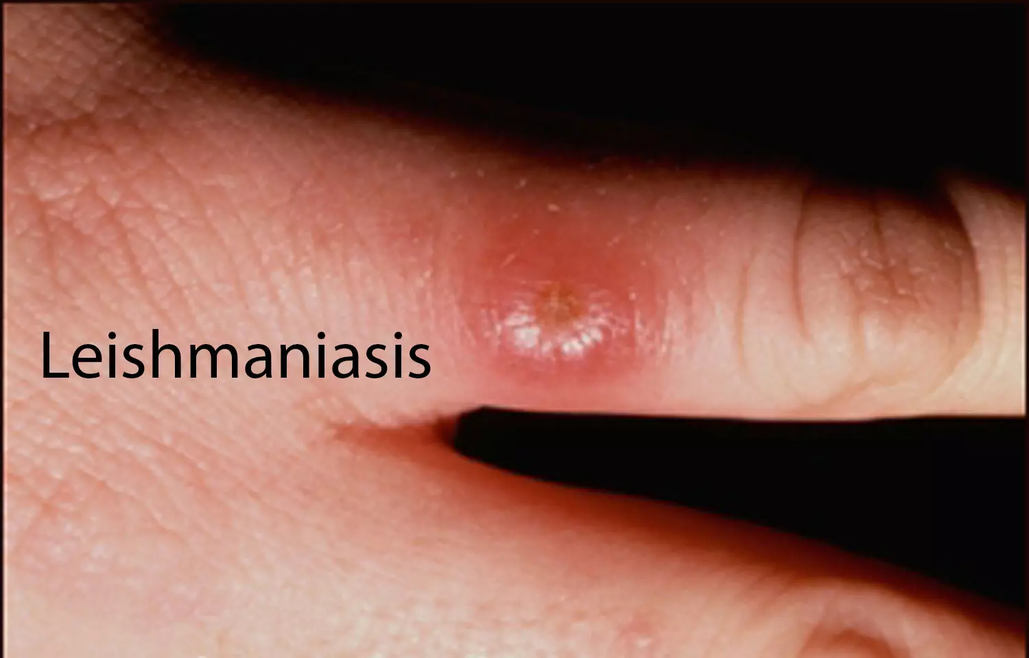 Peptides+antibiotic Combo more effective treatment option for leishmaniasis