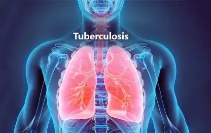 Double Therapy promising treatment of Tuberculosis with C. Difficile, finds study