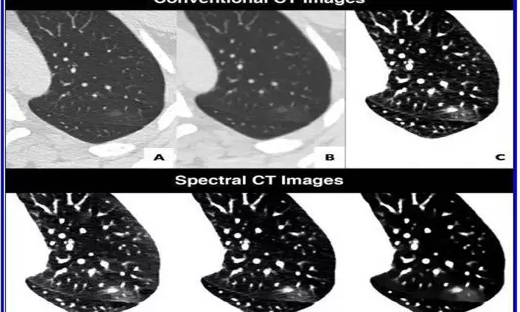 Spectral CT improves detection of early-stage COVID-19