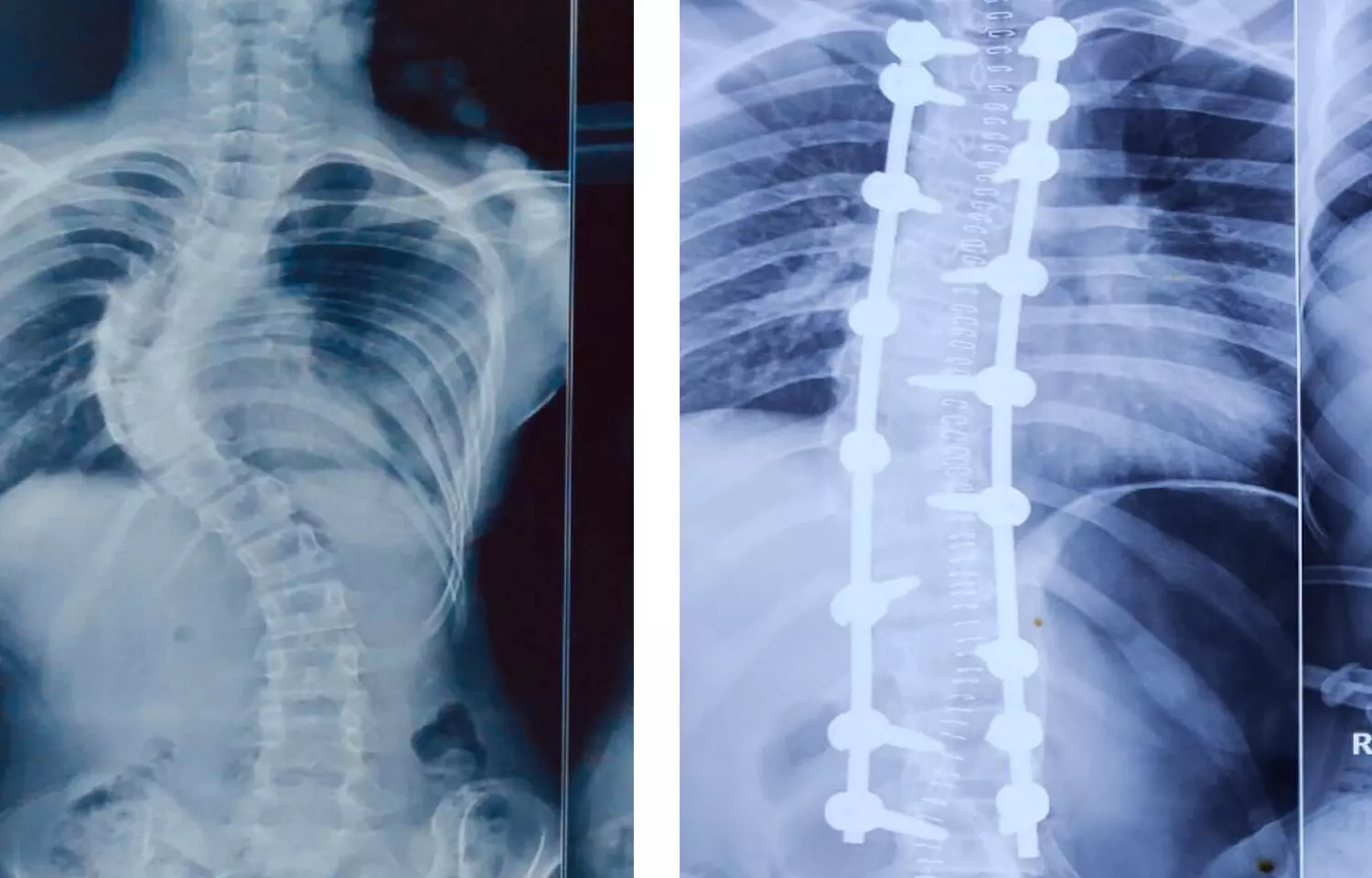 KIMS doctors perform Single Stage Deformity Correction in patient of Scoliosis