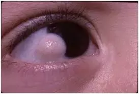 Rare case of Bilateral Retinal Detachment in Goldenhar Syndrome reported in IJO