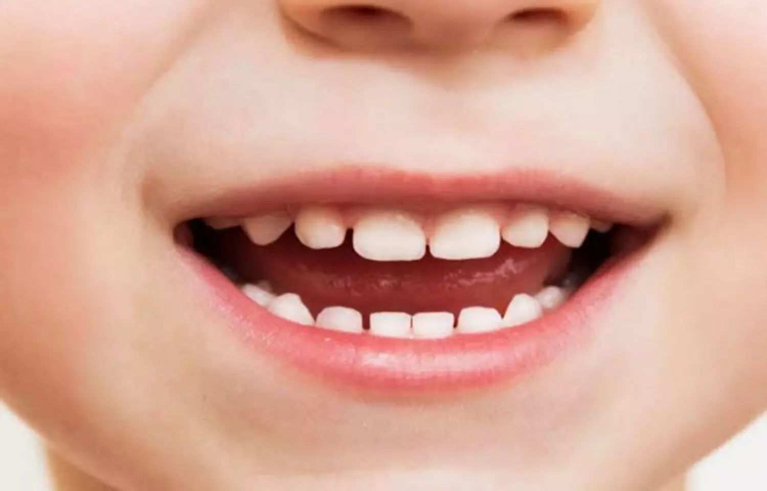 Socioeconomic inequalities tied to severity of dental caries in primary dentition