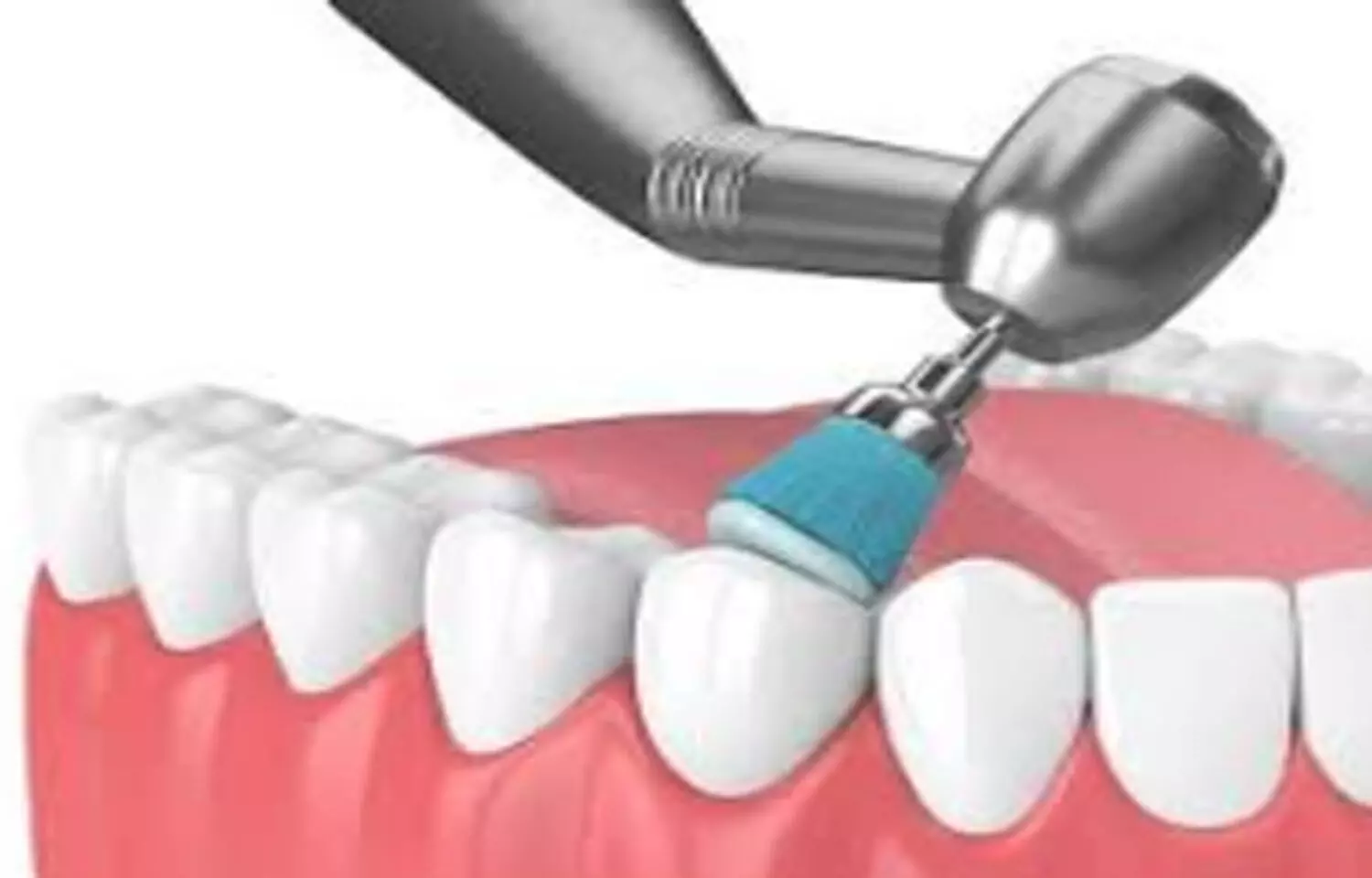 Air Polishing addition to non surgical therapy fails to improve outcomes in Peri-Implantitis: Study Air Polishing addition to non surgical therapy fails to improve outcomes in Peri-Implantitis: Study