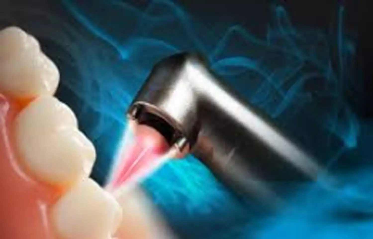 Diode Laser effective in Oral Soft Tissue Biopsies, Study says