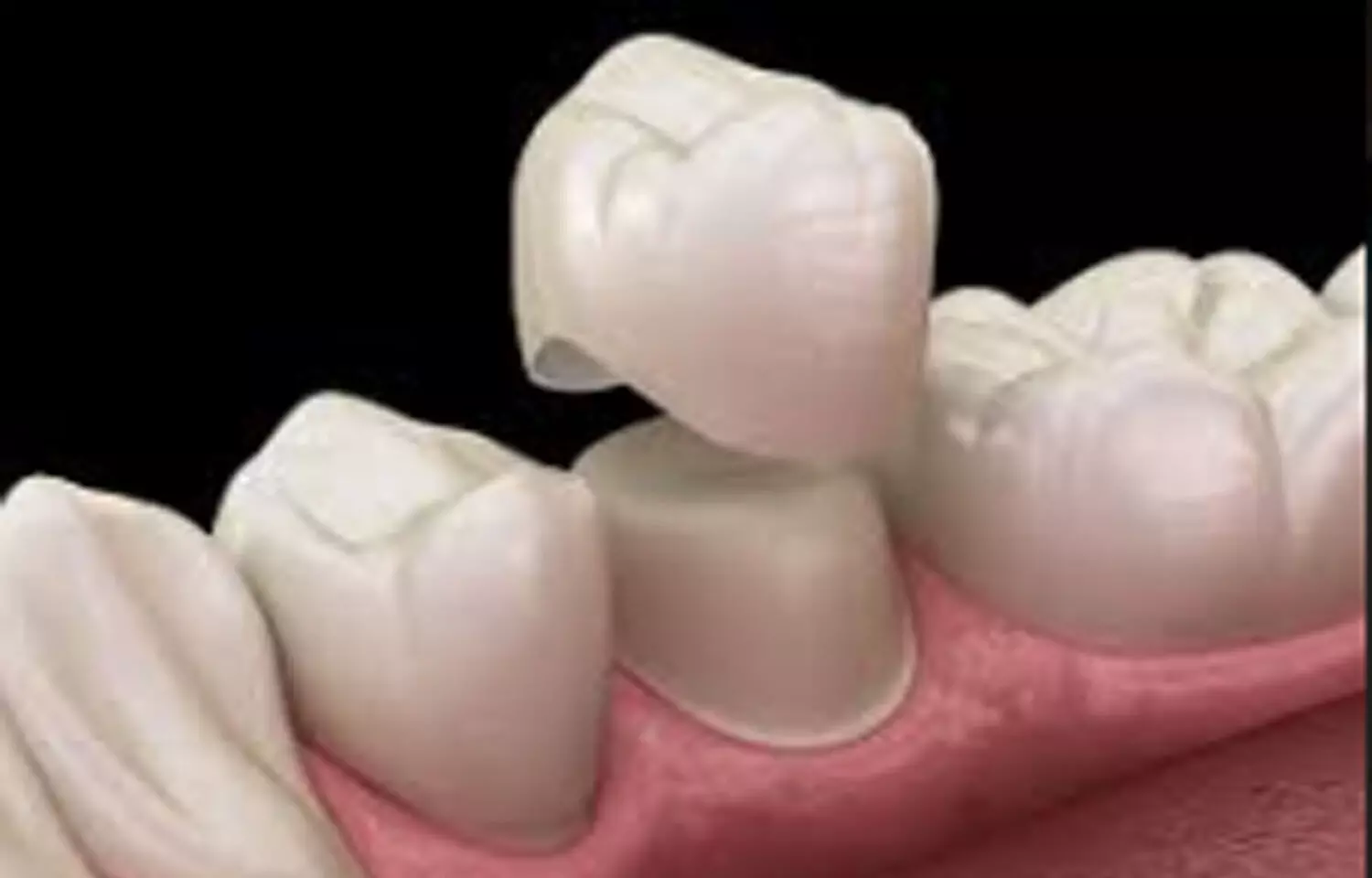 CM cement capable of retaining lithium disilicate crowns, Finds study