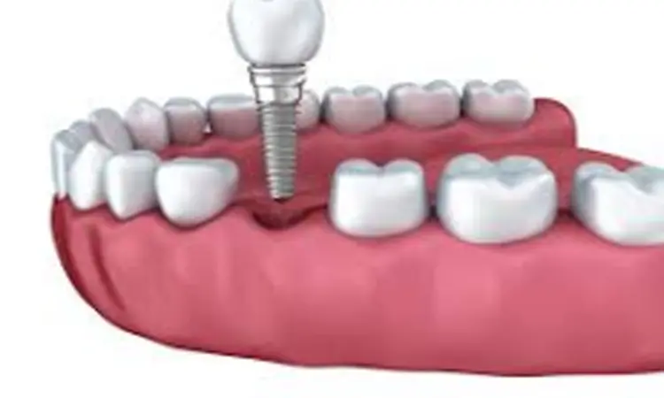 Hybrid implant effective in posterior edentulous maxilla with inadequate bone, Finds study