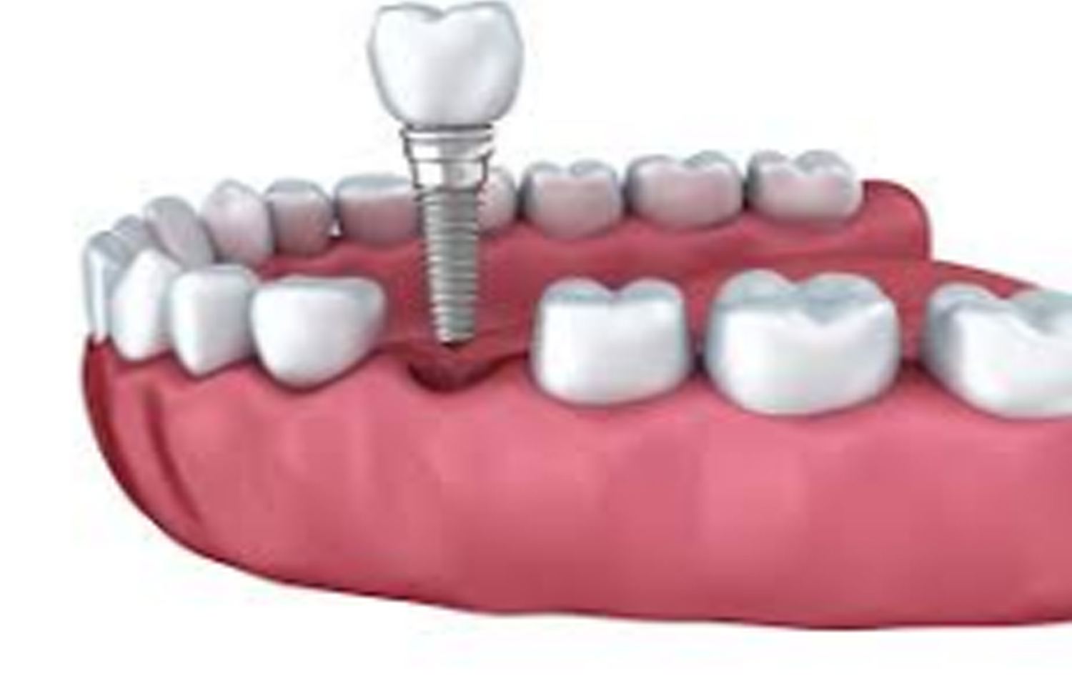 Hybrid implant effective in posterior edentulous maxilla with inadequate bone, Finds study