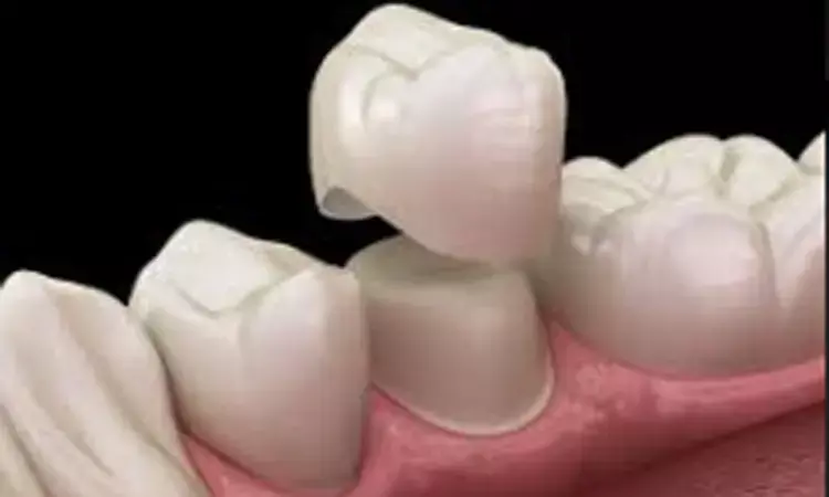 Polished zirconia crowns better than glazed zirconia in terms of wear and tear: Study