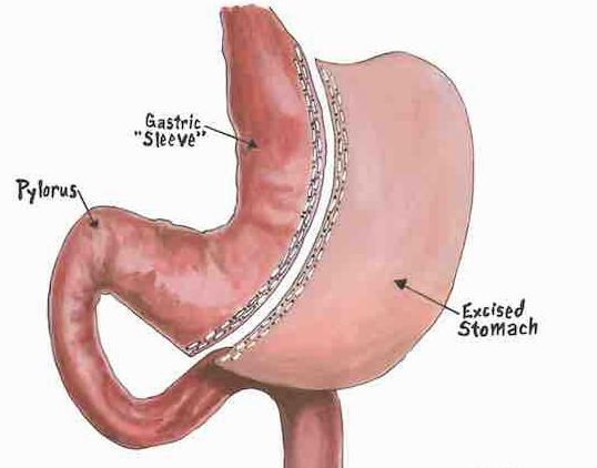 Addition of liraglutide to sleeve gastroplasty tied to superior weight ...