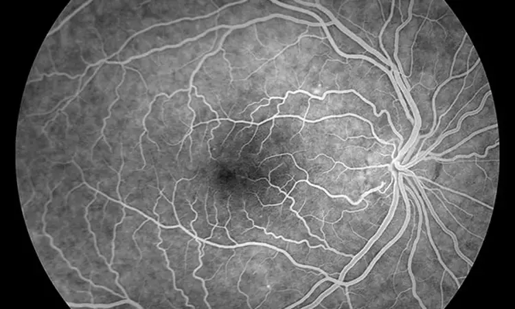 Retinal Vasospasm Similar to Raynauds Phenomenon in a Patient of SLE: Case Report