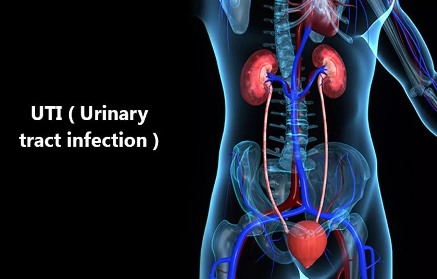 Воспаление мочеполовой системы. Urinary tract. Инфекции мочевыводящих путей. UTI.