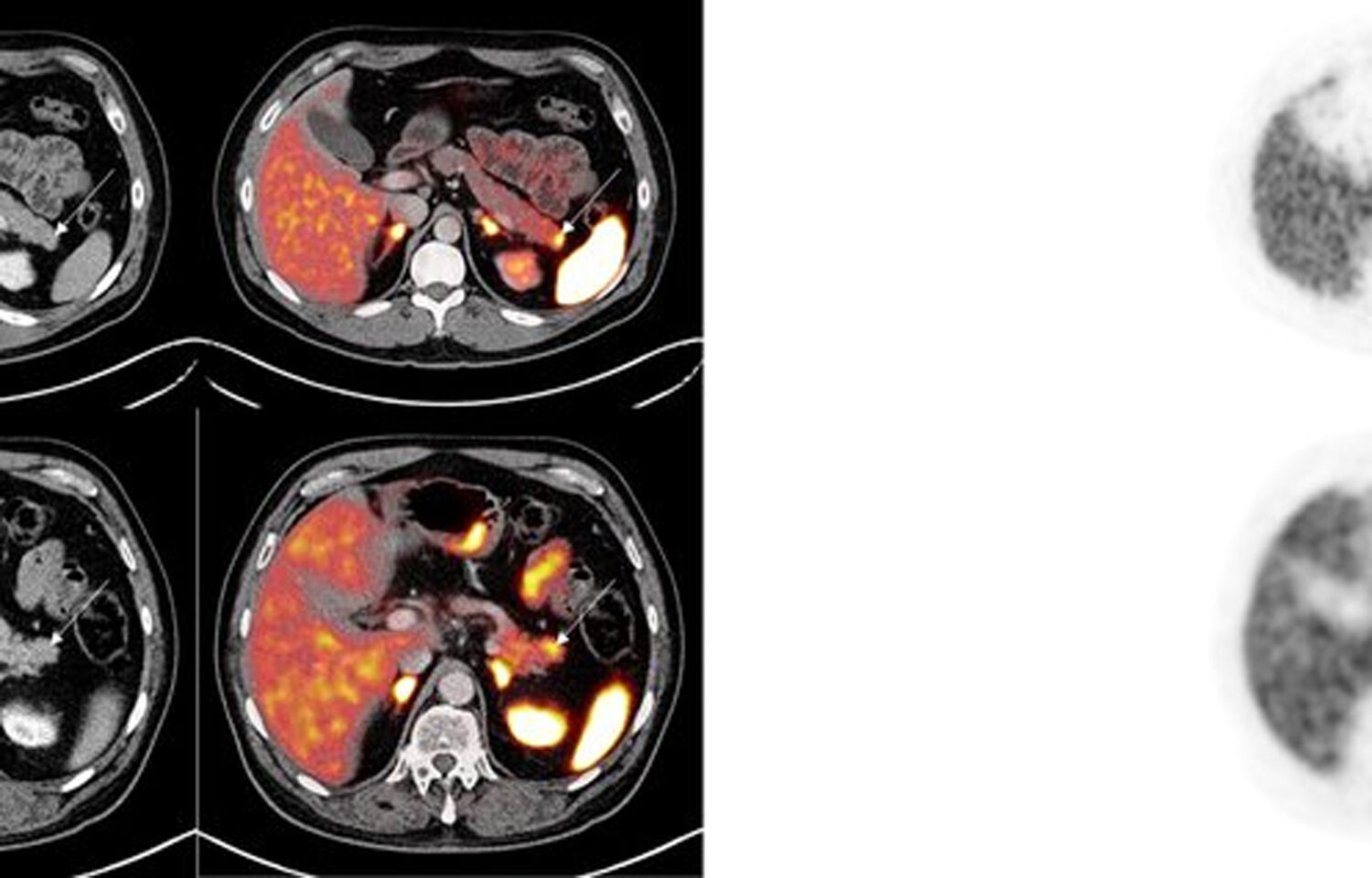 Imaging with PET/CT with Ga-68 tracer helps in accurate staging in