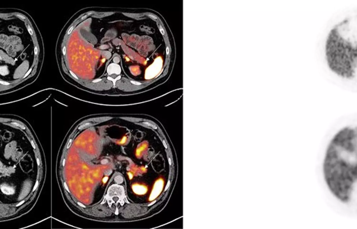 Imaging with PET/CT with Ga-68 tracer helps in accurate staging in cancer patients: Study