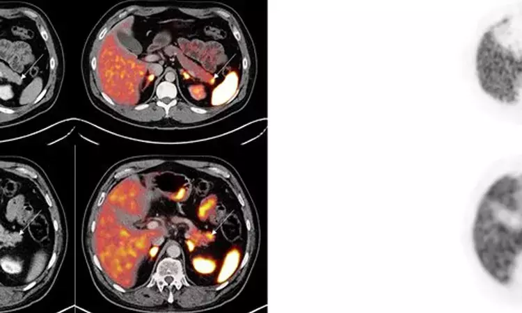 Imaging with PET/CT with Ga-68 tracer helps in accurate staging in cancer patients: Study