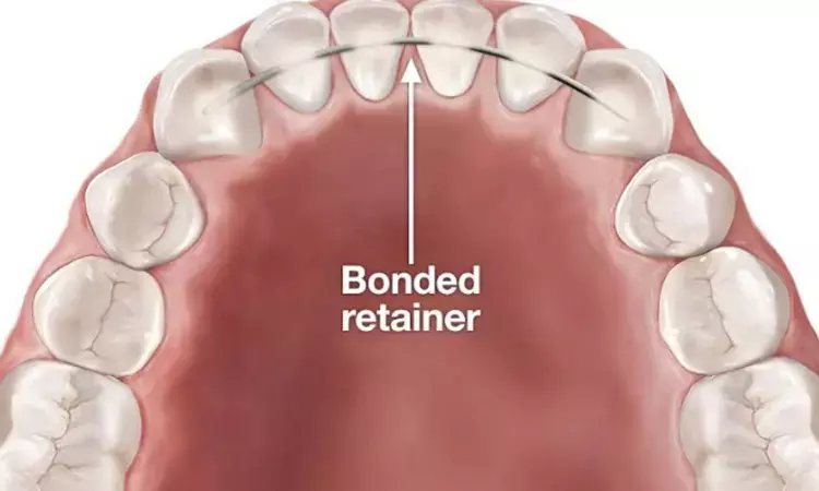 Challenging task- Unwanted tooth movements in-spite of orthodontic retainers