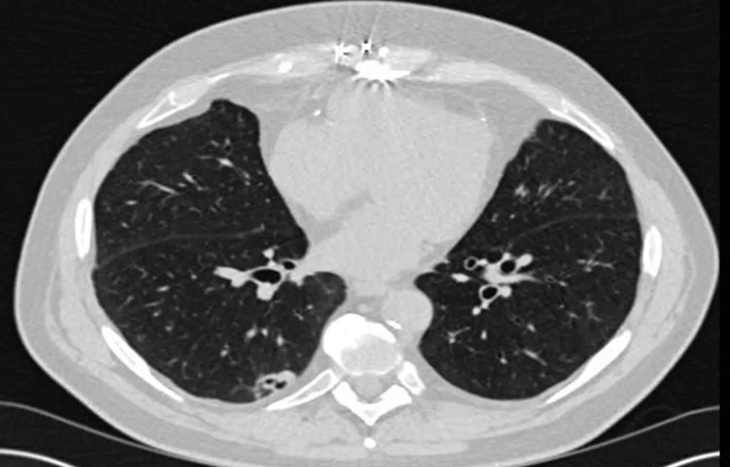 Lung CT scans can also be used for identifying osteoporosis, finds study