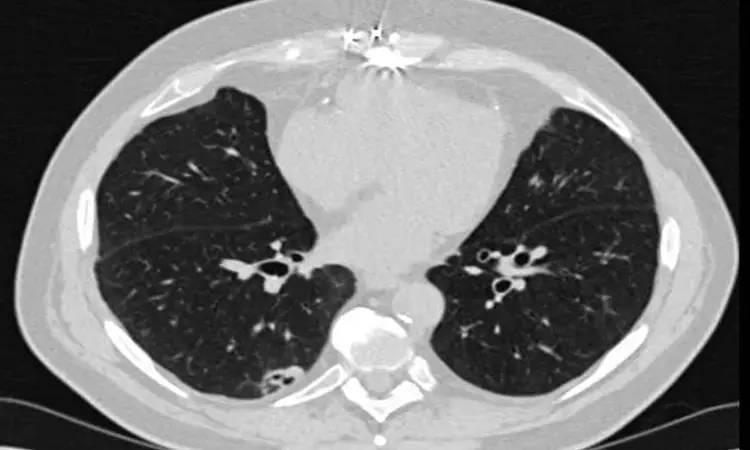 Lung CT scans can also be used for identifying osteoporosis, finds study